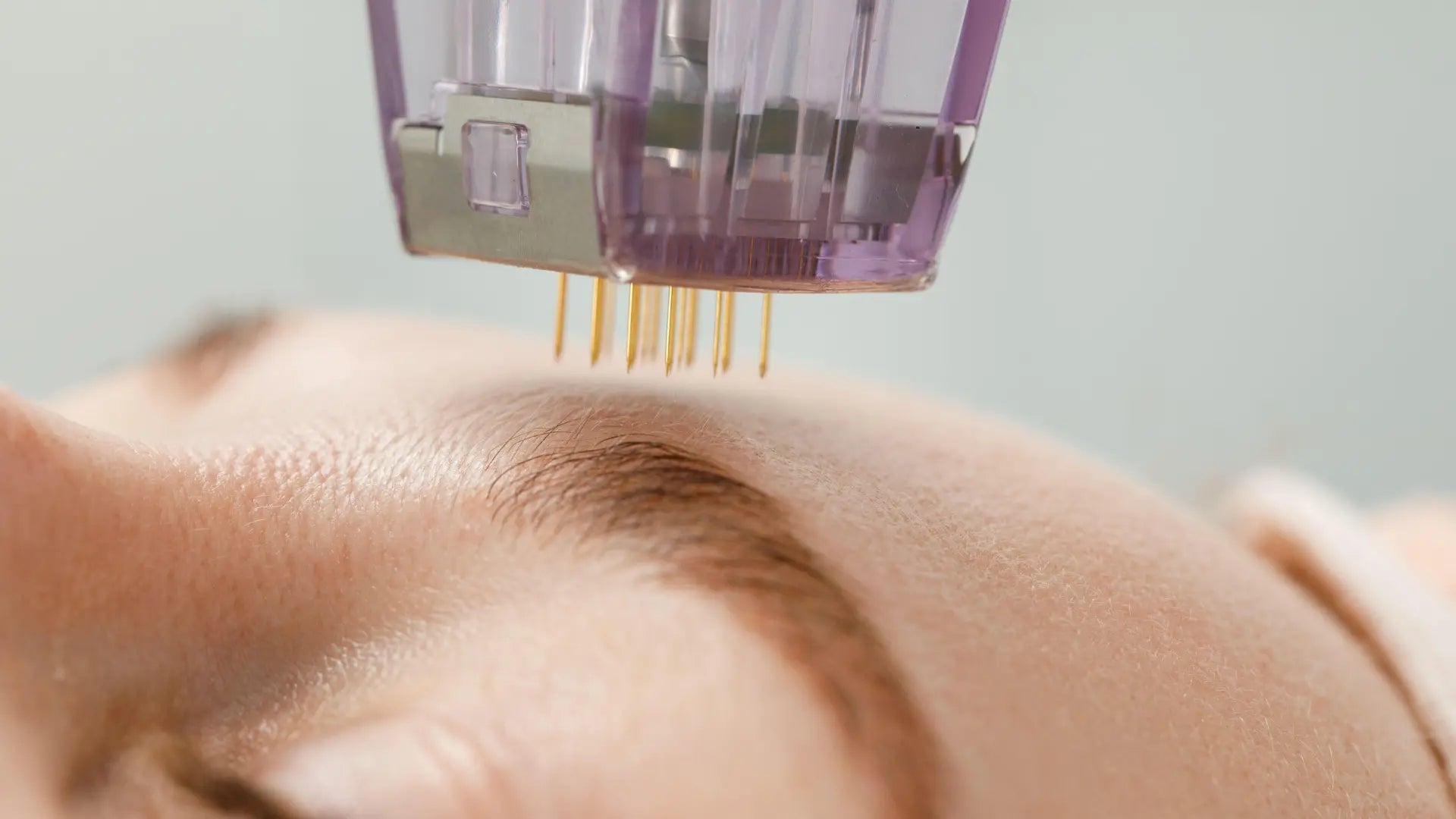 Mesoterapia Corporal: El Tratamiento Estético que Está Revolucionando la Reducción de Grasa Localizada